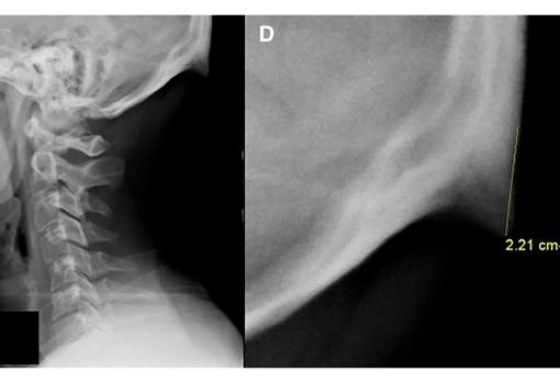 Imágenes de la protuberancia occipital externa