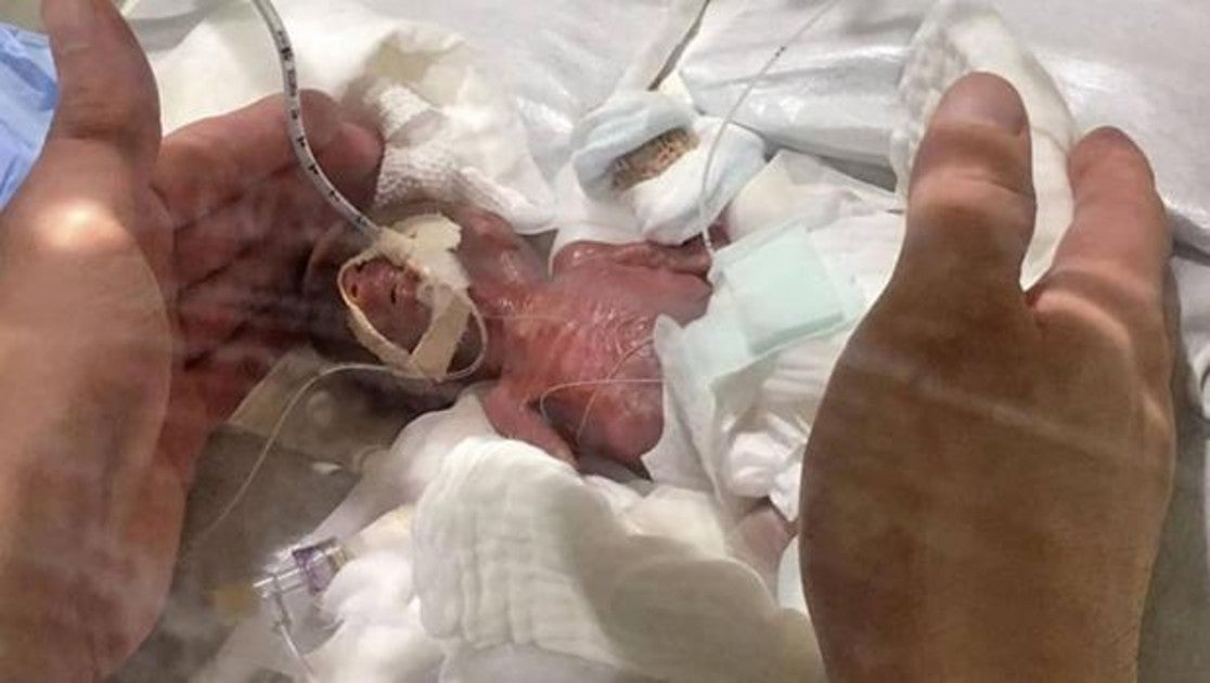 Este Es El Bebe Mas Pequeno Del Mundo Que Sobrevive A Un Parto Prematuro